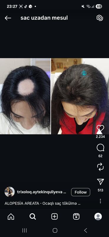 Saçlara qulluq: Saç üçün yağ, Saç tökülməsinə qarşı — 21