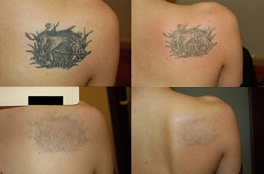 удаление тату лазером цена бишкек: Удаление татуировок