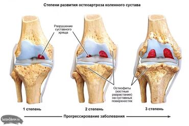 Уход за телом: Бишофит от чего помогает. опорно-двигательного аппарата — 5