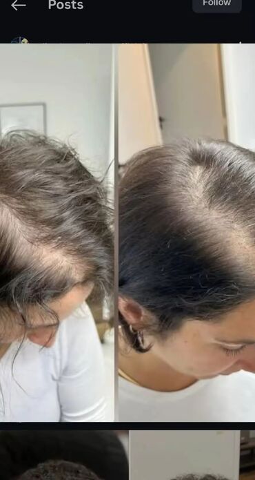 Saçlara qulluq: Saç üçün yağ, Saç tökülməsinə qarşı — 8