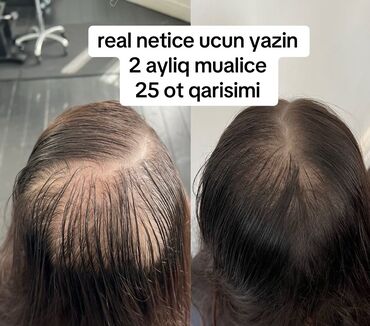 qara sabun sac ucun: Saç maskası, Saç tökülməsinə qarşı