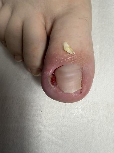 Маникюр: Коррекция вросших ногтей, Услуги подолога, Одноразовые расходные материалы — 2