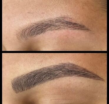 Kirpiklər, qaşlar: Seyrek formasiz qaslarin mikrobledinqle berpasi — 9