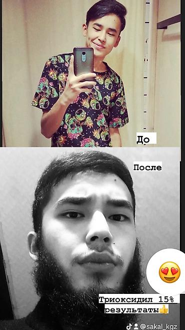 Уход за телом: Миноксидил ультра 15% 100мл 3 месяц хватает Для бороды и волосы — 4