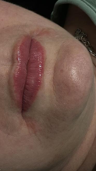 Косметология: Косметология, Увеличение губ, Гипоаллергенные материалы at lalafo.kg — 9 Косметология: Косметология, Увеличение губ, Гипоаллергенные материалы — 9