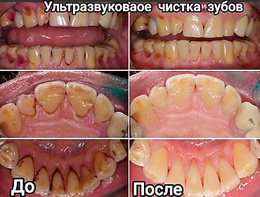 Стоматологи: Съёмные зубные протезы под ваши задачи - Вакуумные протезы: плотная — 14