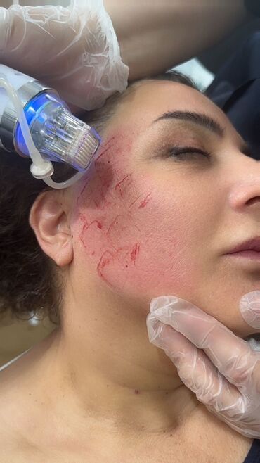 Hicama, zəli: Xidmət: Kupa terapiyası (quru və yaş/hicama), bel–boyun–çiyin masajı — 15