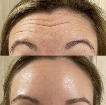 удаление татуажа лазером цена: Косметология, Ботокс, Биоревитализация, Ботулинотерапия, Гипоаллергенные материалы, Сертифицированный косметолог