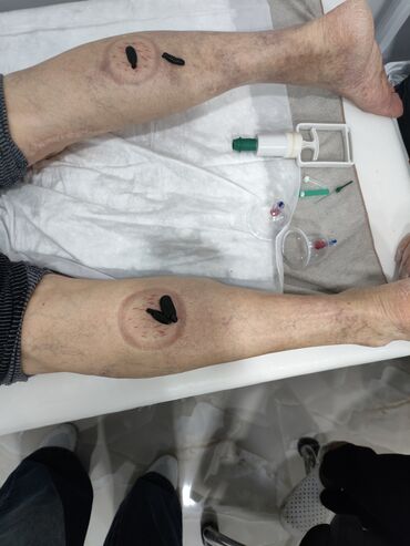 Hicama, zəli: Hicama, quru və yaş vakuum masajı, həmçinin zəli ilə müalicə xidməti — 3