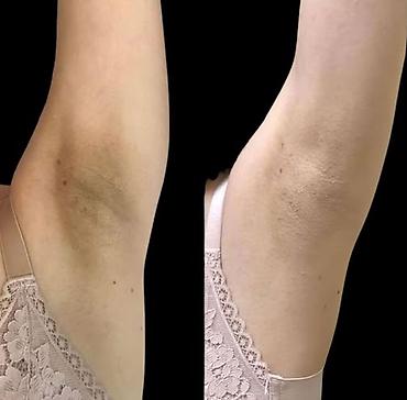 derın dondurucu: Qoltuqaltı, bikini və boyun nahiyəsindəki tündləşmənin azaldılması — 2