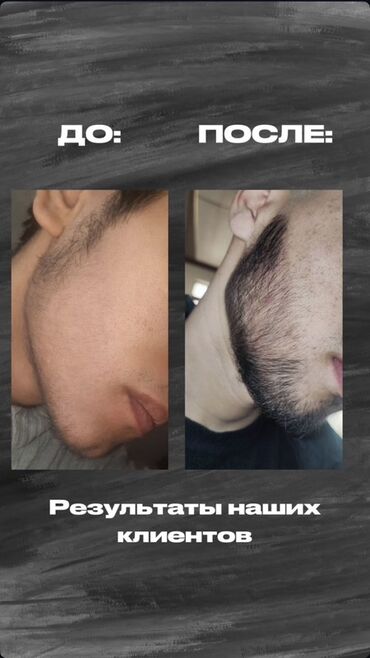 уход за волосами: Миноксидил для роста бороды и волос - Средство для стимуляции роста