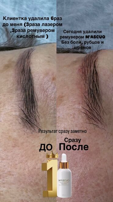 Перманентный макияж: АКЦИЯ !АКЦИЯ! Новый метод удаления Сейчас по акции Лазерное удаление — 12