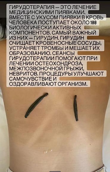 лечение варикоза: Врачи | Гирудотерапевт | Лечение пиявками — 10