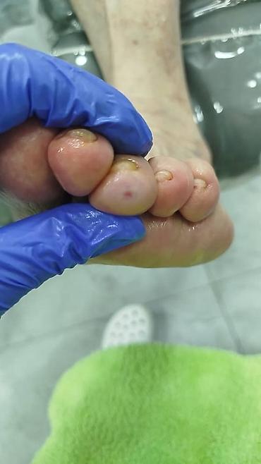 Маникюр: 📢акция с ! Вросший ноготь 📍подологический педикюр,👣 📍мозоли — 4