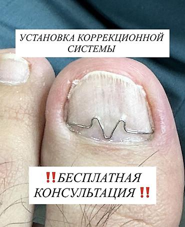 Ичине кирип өскөн тырмактарды оңдоо, Подолог кызматтары, Консультация lalafo.kg да Ичине кирип өскөн тырмактарды оңдоо, Подолог кызматтары, Консультация