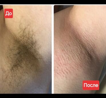 лазерная эпиляция: Мом менен эпиляция, Эркектердин эпиляциясы, Шугаринг, Үйгө баруу кызматы менен