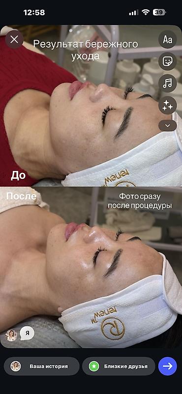 лазерная шлифовка бишкек: Косметолог в Бишкеке | Чистка лица, пилинги, работа с акне — 3