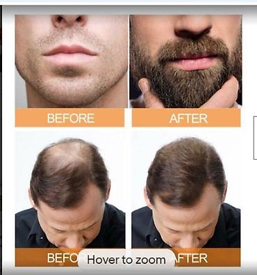 фильер: От Выпадения волос облысения США Minoxidil Оригинал прямые поставки — 6
