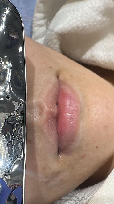 Косметология: Косметология, Увеличение губ, Гипоаллергенные материалы at lalafo.kg — 2 Косметология: Косметология, Увеличение губ, Гипоаллергенные материалы — 2