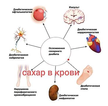 Плакат-схема «Осложнения сахарного диабета» - Наглядная инфографика