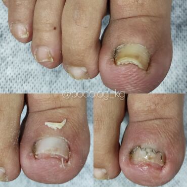 Маникюр, педикюр: Коррекция вросших ногтей, Маникюр, Педикюр, Услуги подолога, Консультация — 8