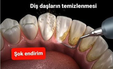 mini telefonlar: Diş daşların temizlenmesi hefte sonu şok endirim