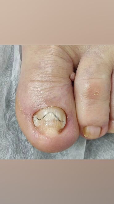 Маникюр, педикюр: Коррекция вросших ногтей, Маникюр, Педикюр, Услуги подолога, Консультация, Одноразовые расходные материалы — 9