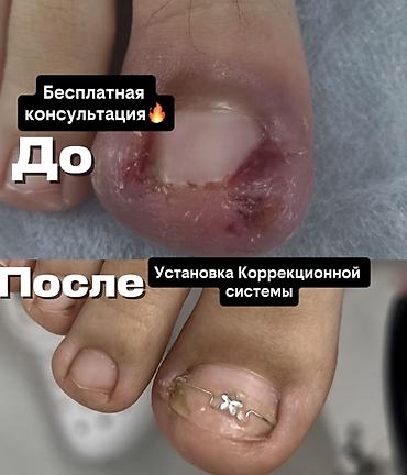 удаление ногтей: Коррекция вросших ногтей, Услуги подолога, Консультация — 1