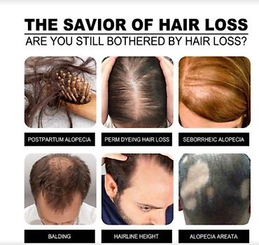 Уход за телом: США средство от облысения от выпадения волос для роста волос будит — 5