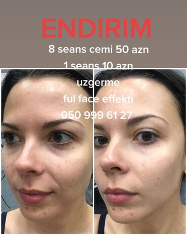 elxan elatli qan lekesi pdf: Kosmetologiya | Biorevitalizasiya, Liftinq, Arıqlama prosedurları