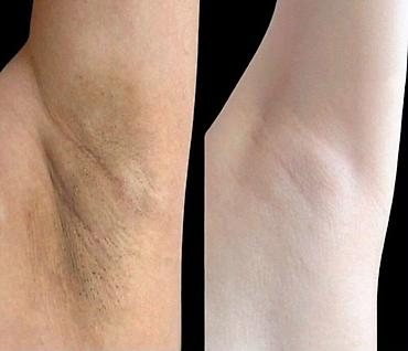 derın dondurucu: Qoltuqaltı, bikini və boyun nahiyəsindəki tündləşmənin azaldılması — 3