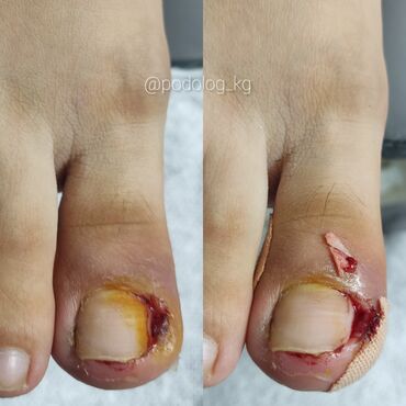 Маникюр, педикюр: Коррекция вросших ногтей, Педикюр, Услуги подолога, Консультация, Одноразовые расходные материалы — 9