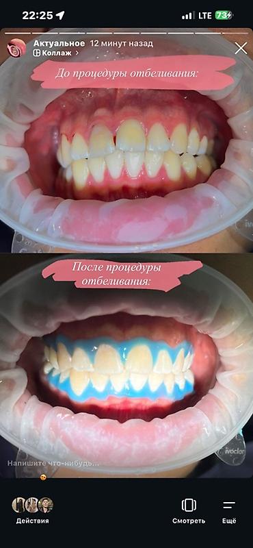 стоматологи: Профессиональная гигиена+отбеливание зубов=3800c - Комплекс услуг — 1