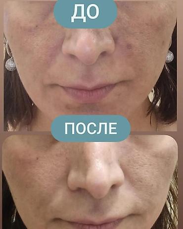 expigment реальные отзывы: Expigment Экспигмент Сроки до 2027 Свежая поставка с Турции 🇹🇷 💯% — 5