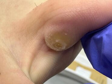 Маникюр, педикюр: Коррекция вросших ногтей, Педикюр, Услуги подолога, Консультация, Одноразовые расходные материалы — 5