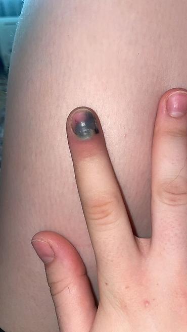 удаление папилом: Дерматолог — 1