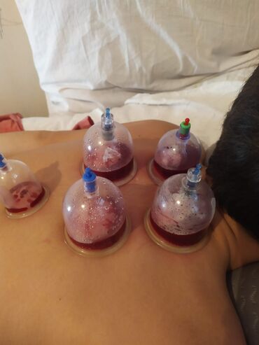 Hicama, zəli: Hicama, quru və yaş vakuum masajı, həmçinin zəli ilə müalicə xidməti — 6