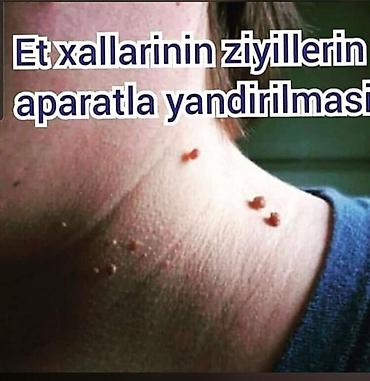 Hicama, zəli: Xidmət: Hicama, zəli qoyulması və aparatlа dəri törəmələrinin — 3