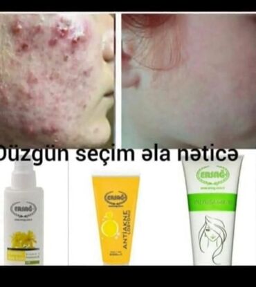 Göz üçün kosmetika: Üz kremi, Akneyə meyilli dəri üçün
