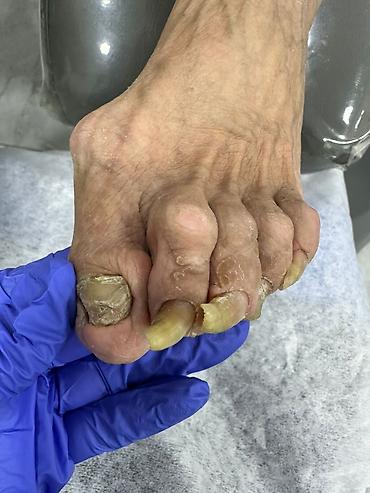 Маникюр: 📢акция с ! Вросший ноготь 📍подологический педикюр,👣 📍мозоли — 8