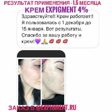 красота и здоровья: Крем Expigment напрямую с Турции. В составе гидрохинон. доставка по