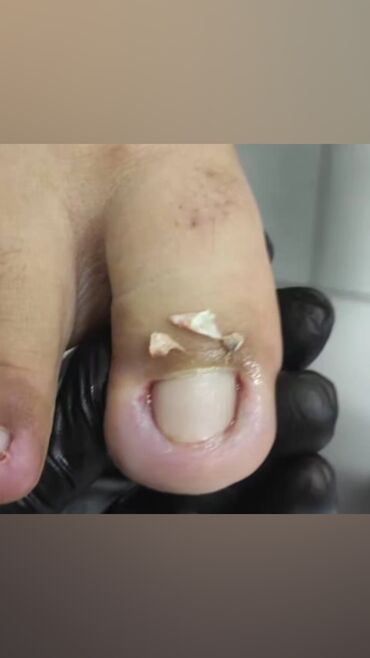 Маникюр, педикюр: Коррекция вросших ногтей, Выравнивание, Услуги подолога, Маникюр, Педикюр, С выездом на дом, Консультация, Одноразовые расходные материалы — 11