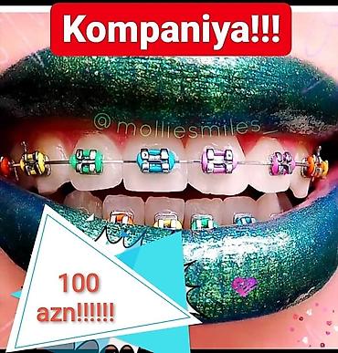сколько стоят брекеты в баку: İnstaqram dr.zerif). Seçilən pasientlerə sonda kappa hədiyyə — 2