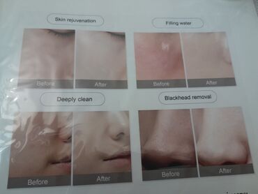 Kosmetoloji aparatlar: Darsonval, Pilinq, Brosaj, Üz üçün, Dəri üçün, Bədən üçün — 12