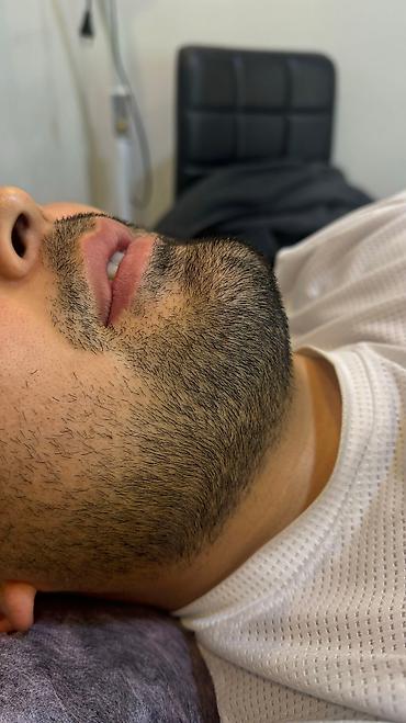 Эпиляция: Мужской шугаринг. Восковая депиляция — 9