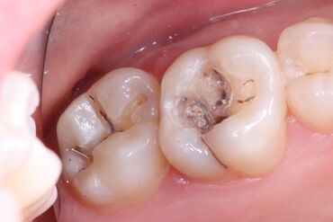 оборудование для парикмахерской: Эстетическая реставрация жевательных зубов композитом -