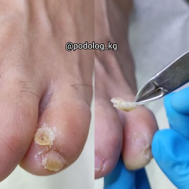 Маникюр, педикюр: Коррекция вросших ногтей, Маникюр, Педикюр, Услуги подолога, Консультация — 15