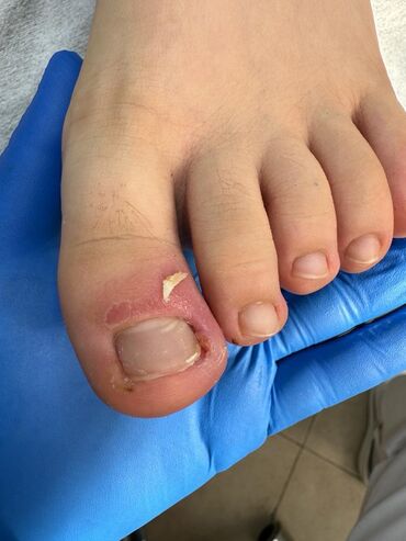 Маникюр, педикюр: Вросший ноготь. Коррекция вросшего сегмента путем удаления врастающих — 9