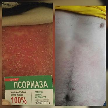 мазь cortam: Здравствуйте! Найден эффективный способ от Псориаза. Я сам болею этой — 9