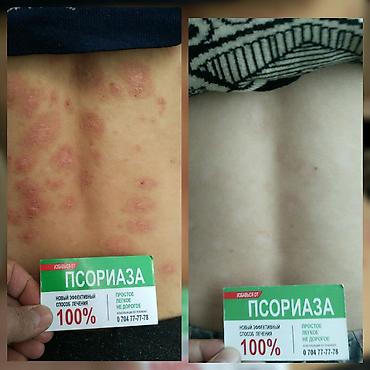 мазь cortam: Здравствуйте! Найден эффективный способ от Псориаза. Я сам болею этой — 5
